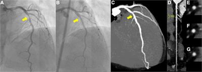 Percutaneous coronary intervention for a healed erosion with excimer laser coronary angioplasty and drug-coated balloon angioplasty: a case report